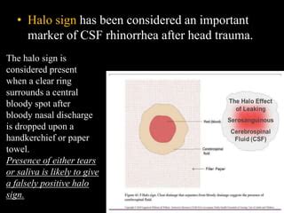 halo sign csf|Halo sign